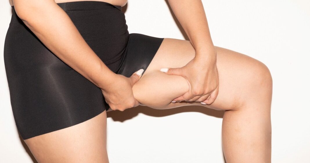 Ilustración médica que muestra una comparación visual entre una pierna sana y una con lipedema, destacando la acumulación de grasa nodular.