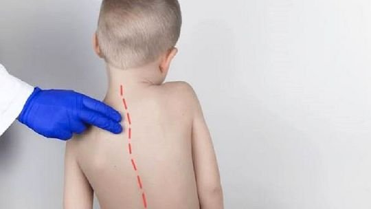 Imagen ilustrativa de escoliosis en un niño