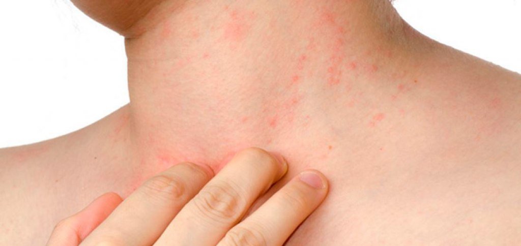 Niño con dermatitis atópica en el brazo